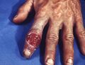 Extragenital syphilitic chancre of the left index finger PHIL 4147 lores.jpg