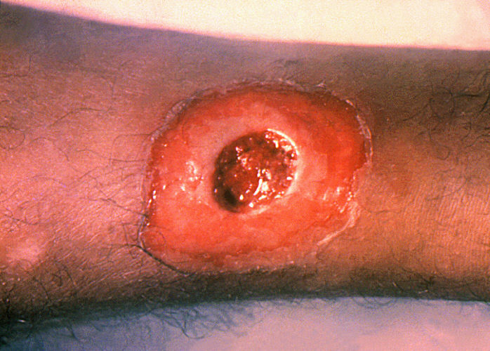 Plik:A diphtheria skin lesion on the leg. PHIL 1941 lores.jpg