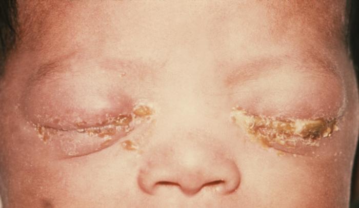 Plik:Gonococcal ophthalmia neonatorum.jpg