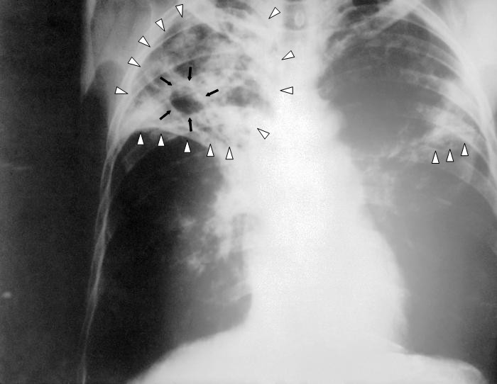 Plik:Tuberculosis-x-ray-1.jpg