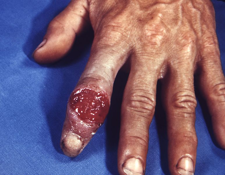 Plik:773px-Extragenital syphilitic chancre of the left index finger PHIL 4147 lores.jpg