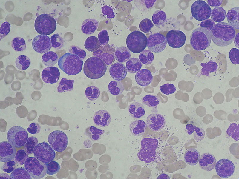 Plik:Chronic Myeloid Leukemia smear 2009-04-09.JPG