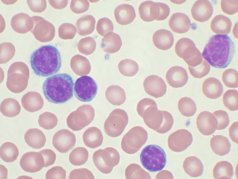 Plik:Chronic lymphocytic leukemia.jpg