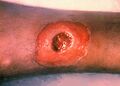 A diphtheria skin lesion on the leg. PHIL 1941 lores.jpg