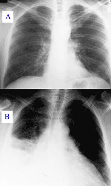 Plik:Pneumonia x-ray.jpg