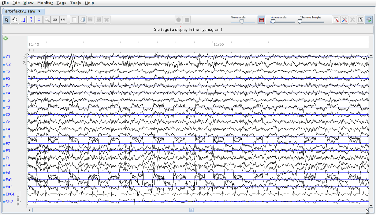 Pracownia EEG EEG Spoczynkowe Brain wiki