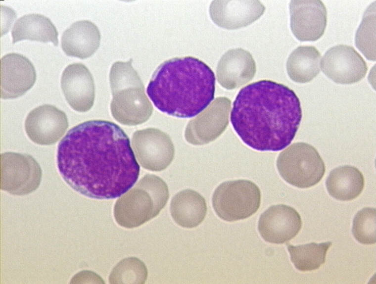 Plik:ALL - Peripherial Blood - Diagnosis - 01.jpg